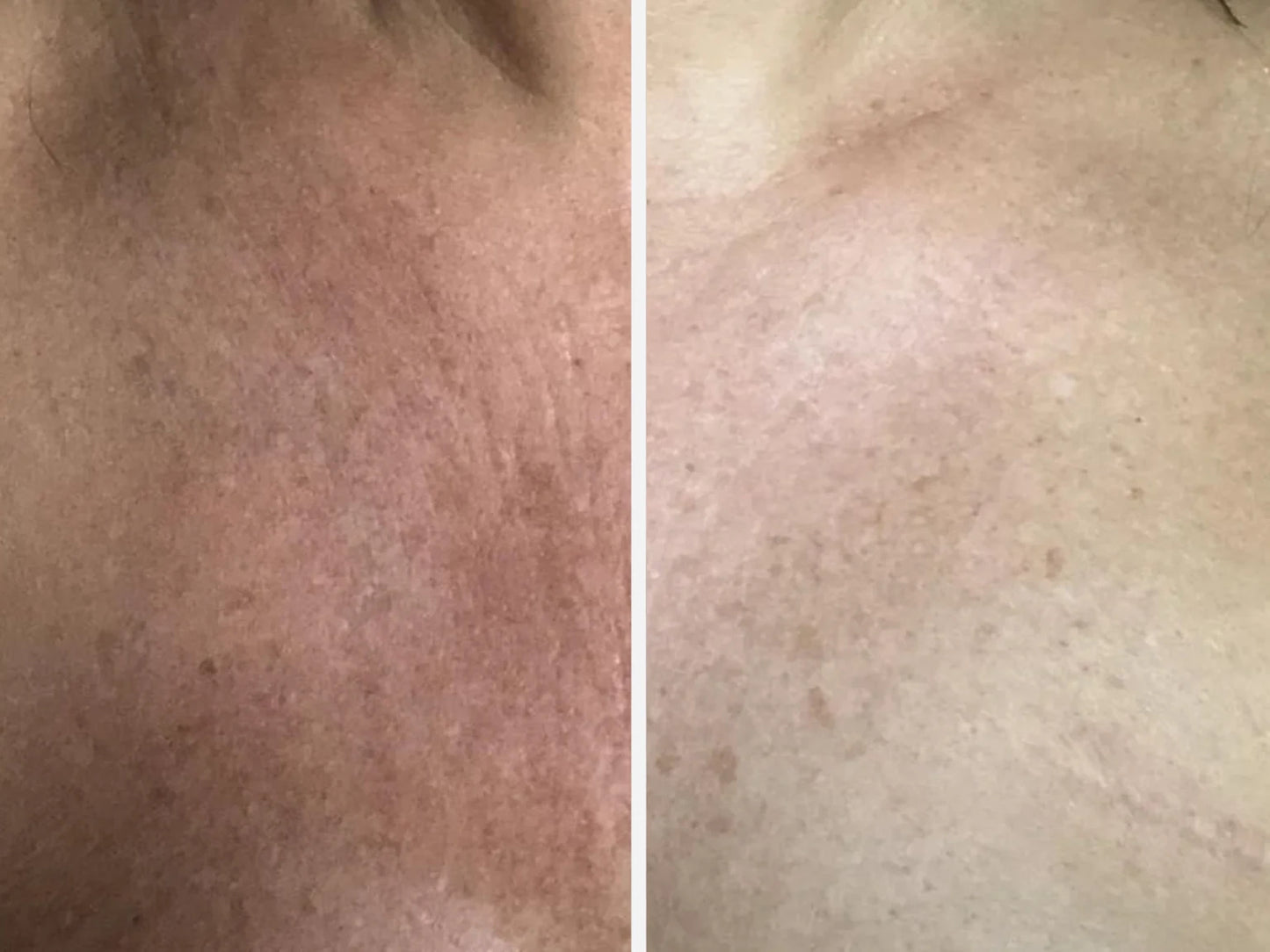 Patch bioderme Eskyn™ – Poitrine